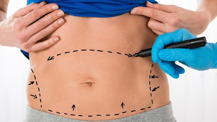 Karın germe estetiği hakkında merak edilenler