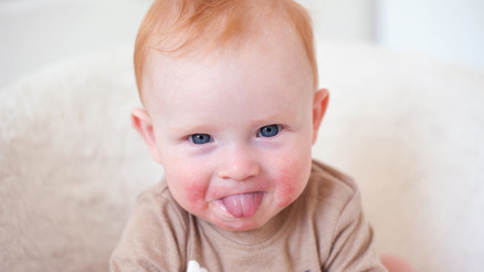 Anne ya da babası alerjik olan çocuklar daha riskli