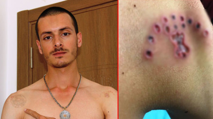 Sildirmek istediği dövmeler kabusu oldu Cildi çürüdü...