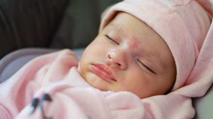 Bebeklerde doğum lekesi neden olur Doğum lekesi türleri nelerdir