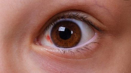 Kırmızı göz hastalığı nedir, bulaşıcı mı, belirtileri neler Konjonktivit hastalığı ile ilgili bilgiler