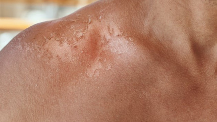 Cilt Soyulması Kalıcı Lekeye Sebep Olabilir Cilt Soyulması Kalıcı Lekeye Sebep Olabilir