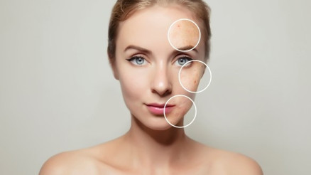 Covid-19 İle Başlayan Sivilce Pandemisi