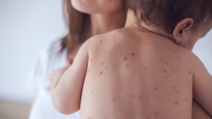 Aşı karşıtlığında artış var… Kızamık tehlikesi geri mi dönüyor