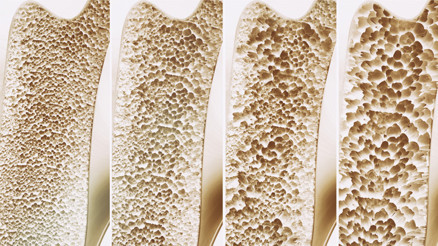 Kemik erimesi neden olur Kemik erimesine karşı 6 etkili önlem Kemik erimesi neden olur Kemik erimesine karşı 6 etkili önlem