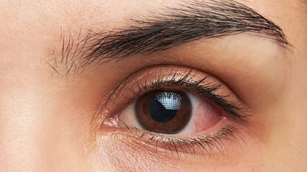 Göz kızarıklığı hangi durumda Covid-19 işareti olabilir