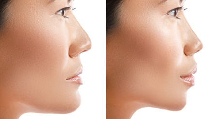 Çene dolgusu nasıl yapılır