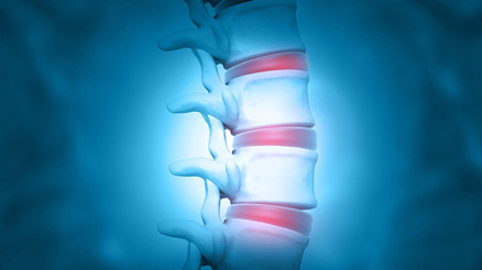 Fıtık nedir Belirtileri nelerdir