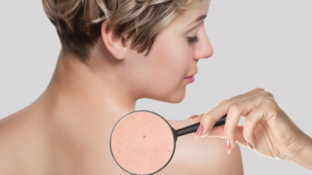 Ciltteki kahverengi lekeler nasıl geçer