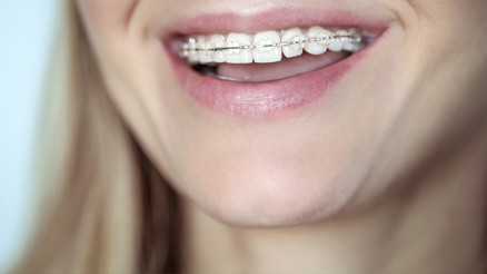 Ortodontik tedaviler hakkında merak edilenler