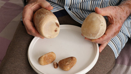 73 yaşındaki hastanın mesanesinden 2 kilo taş çıktı