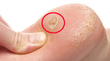 Nasır tedavisi nasıl yapılır, kesin çözümü var mı Nasır tedavisi nasıl yapılır, kesin çözümü var mı