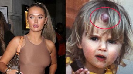 Molly- Mae Hague takipçilerini şoke etti: Alnımda böyle bir leke vardı