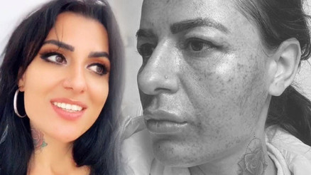 Güzellik merkezinde hayatının şokunu yaşadı Yüzü yandı, tehdit edildi...