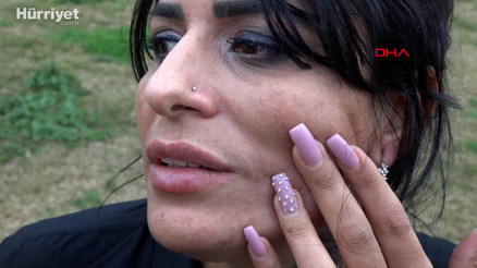 Güzellik merkezinde yüzü yanan Aslı: Sosyal medyadaki reklamlarına kandım