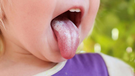 Pamukçuk nedir ve nasıl geçer Bebeklerde ve çocuklarda pamukçuk tedavisi