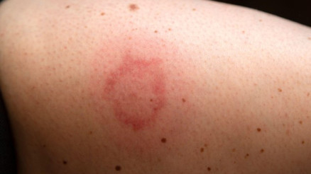 Böcek Isırığı Nasıl Olur Ve Nasıl Anlaşılır Böcek Isırığı Nasıl Geçer Ve Ne İyi Gelir