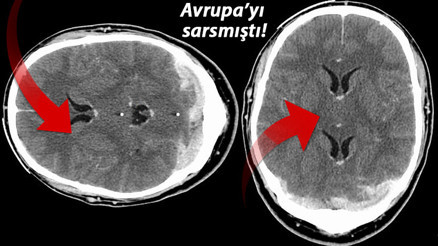 Son dakika haberler... AstraZeneca aşısında flaş gelişme: Yan etkinin gizemini açıkladılar