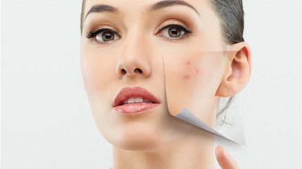 Sivilce izi nasıl geçer Sivilce izi tedavisi hakkında bilgiler