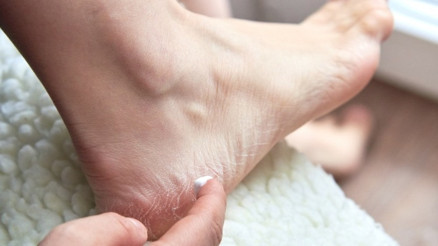 Topuk çatlaklarına ne iyi gelir Topuk çatlaklarından kurtulmanın doğal yolları Topuk çatlaklarına ne iyi gelir Topuk çatlaklarından kurtulmanın doğal yolları