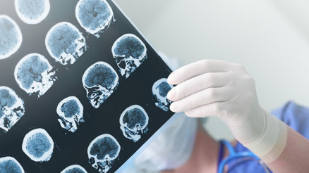 Parkinson hastalığı nedir Parkinson belirtileri ve tedavisi Parkinson hastalığı nedir Parkinson belirtileri ve tedavisi