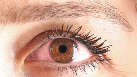 Göz kanlanması neden olur, nasıl geçer Evde göz kanlanmasına iyi gelen tedaviler