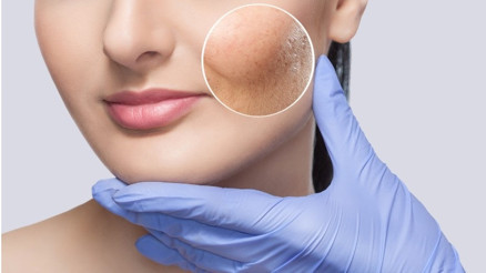 Thulium cilt yenileme lazeri nedir