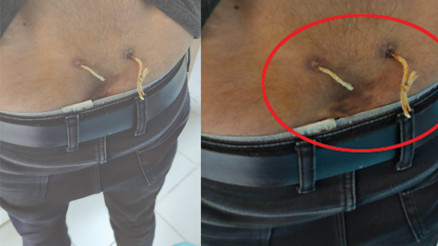 ‘Alternatif tıp’ adı altında yapılan işkencede son nokta: Çamaşır ipiyle bel tedavisi ‘Alternatif tıp’ adı altında yapılan işkencede son nokta: Çamaşır ipiyle bel tedavisi