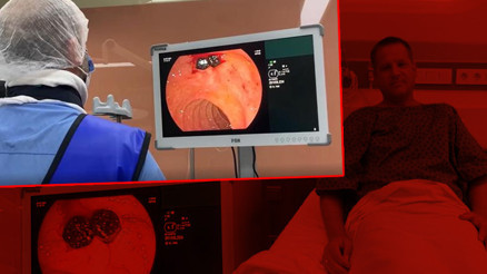 Karın ağrısı şikayetiyle gitti, hayatının şokunu yaşadı 50 tane taş çıkarıldı Karın ağrısı şikayetiyle gitti, hayatının şokunu yaşadı 50 tane taş çıkarıldı