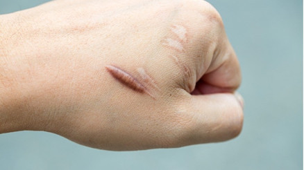 Keloid nedir Tedavi edilebilir mi