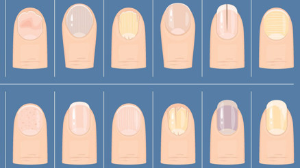 Bana tırnağını göster sana hastalığını söyleyeyim | Milyonlarca izlenen videodan sonra gündem tırnaklar...