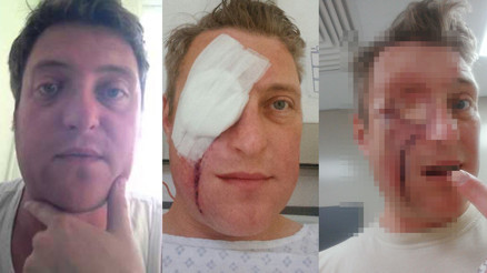 Önce Enfeksiyon sanıldı, yüzünde dev bir delikle hastaneden ayrıldı...