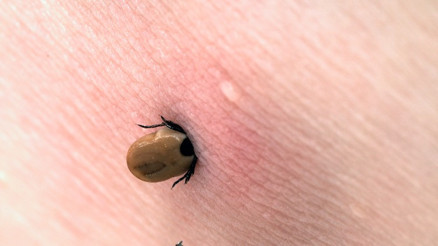 Lyme Hastalığı Nedir, Nasıl Bulaşır Lyme Hastalığı Belirtileri ve Tedavisi Lyme Hastalığı Nedir, Nasıl Bulaşır Lyme Hastalığı Belirtileri ve Tedavisi