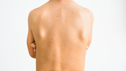 Madalyon hastalığı (Gül hastalığı) nedir, bulaşıcı mı Madalyon hastalığı sebepleri ve belirtileri Madalyon hastalığı (Gül hastalığı) nedir, bulaşıcı mı Madalyon hastalığı sebepleri ve belirtileri