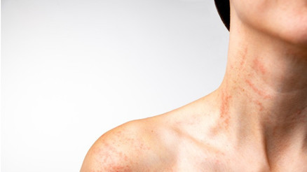 Ürtiker (Kurdeşen) nedir, neden olur Ürtiker belirtileri ve tedavi yöntemleri