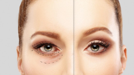 Göz Kapağı Ameliyatı Nasıl, Kimlere Yapılır Göz Kapağı Ameliyatı Nasıl, Kimlere Yapılır