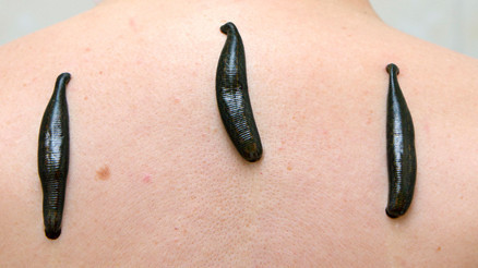 Sülük tedavisinin tıpta yeri var mı ‘Hepatit türevi kan hastalıkları bulaşabilir…’ 7 SORU 7 YANIT