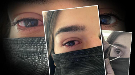 Şimdi de gözlerde virüs salgını; uzmanlar adenovirüse karşı uyarıyor