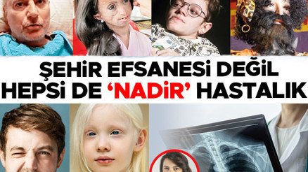 Şehir efsanesi değil hepsi de nadir hastalık Şehir efsanesi değil hepsi de nadir hastalık