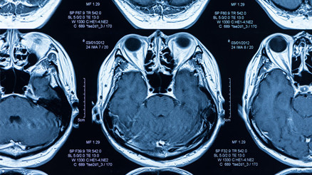 Herkesin konuştuğu ürkütücü araştırma Covid-19 beyni küçültüyor... Peki hafif geçirenler de etkileniyor mu Herkesin konuştuğu ürkütücü araştırma Covid-19 beyni küçültüyor... Peki hafif geçirenler de etkileniyor mu