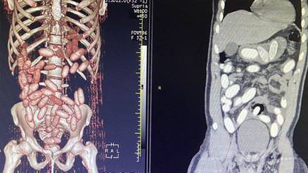 İstanbul Havalimanında 7 yolcunun midesinden 11 kilo kokain çıktı