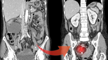 9 kiloluk tümörü görenler şaşkına döndü Özellikle genç kadınlarda çok yaygın... 9 kiloluk tümörü görenler şaşkına döndü Özellikle genç kadınlarda çok yaygın...