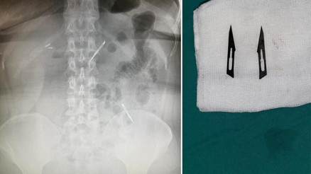 Ankarada şaşkına çeviren olay Karın ağrısı şikayetiyle gitti, 2 tane neşter yuttuğunu öğrendi