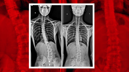 Bisiklet kazası sonrası fark ettiler 2 ayda inanılmaz değişim