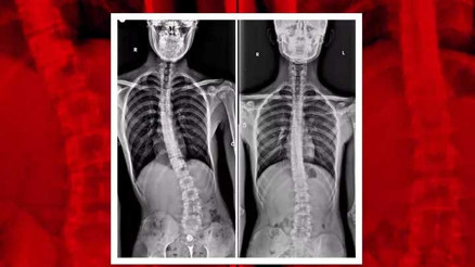 Bel ağrısı sandı, omuriliğinde tümör olduğu teşhis edildi