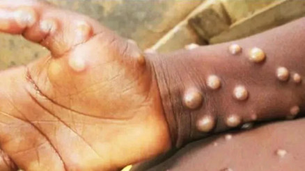 Maymun çiçeği pandemiye sebep olur mu Hastalık Türkiyede görüldü mü İşte Maymun çiçeği hastalığı ile ilgili son durum