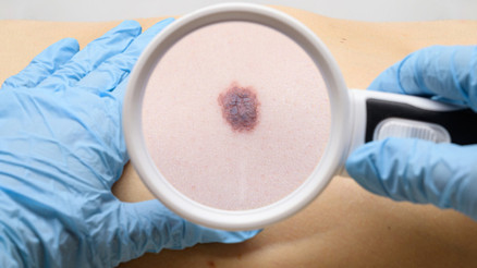 Çocukluğundaki güneş yanığı 40 yıl sonra kansere sebep oldu… ‘Güneşe bir kez maruz kalmak bile yeterli’ Çocukluğundaki güneş yanığı 40 yıl sonra kansere sebep oldu… ‘Güneşe bir kez maruz kalmak bile yeterli’