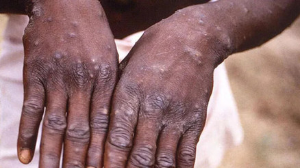 Maymun çiçeği Türkiyede var mı Maymun çiçeği virüsü nedir, nasıl bulaşır... İşte hastalığın belirtileri