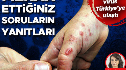 Korkutan maymun çiçeği virüsü Türkiyede