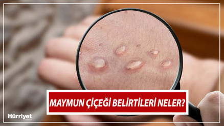 Maymun çiçeği nedir, nasıl anlaşılır Maymun çiçeği virüsü belirtileri nelerdir İşte tedavisi ve semptomları hakkında bilgiler